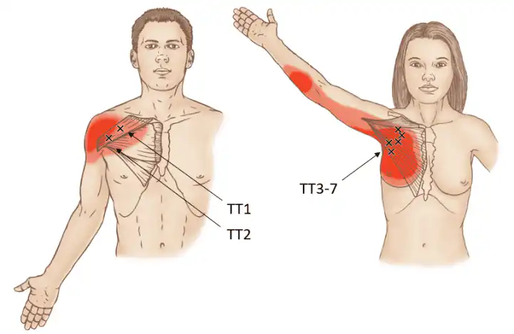 Триггерные точки большой грудной мышцы